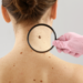 Skin health, moles, check