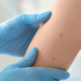 Skin cancer, skin health, moles, health check